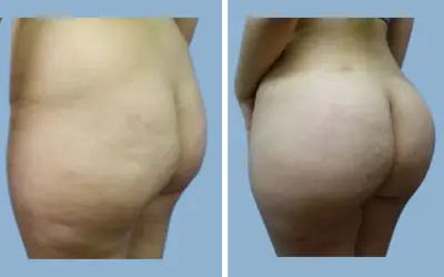 Brazilian butt lift before and after result 15 - BBL performed in India, IndiCure patient