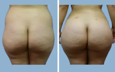 Brazilian butt lift before and after result 16 - BBL performed in India, IndiCure patient