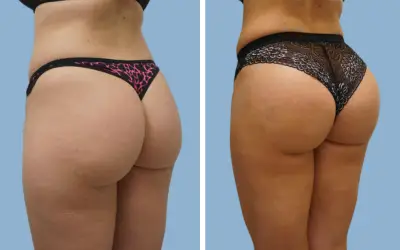 Brazilian butt lift before and after result 2 - BBL performed in India, IndiCure patient