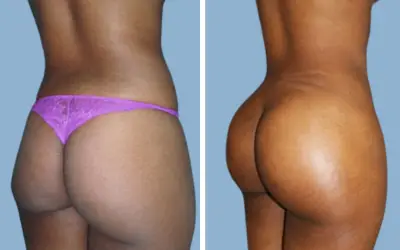 Brazilian butt lift before and after result 3 - BBL performed in India, IndiCure patient