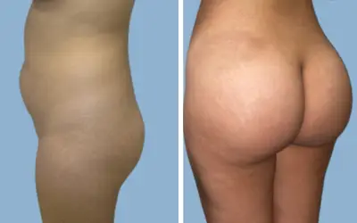 Brazilian butt lift before and after result 4 - BBL performed in India, IndiCure patient