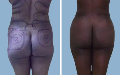 Brazilian butt lift before and after result 5 - BBL performed in India, IndiCure patient