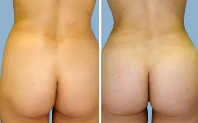 Brazilian butt lift before and after result 6 - BBL performed in India, IndiCure patient