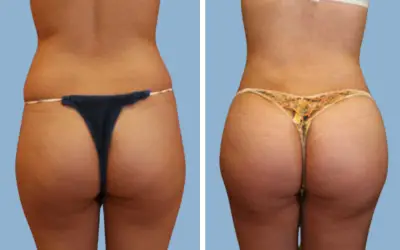 Brazilian butt lift before and after result 7 - BBL performed in India, IndiCure patient