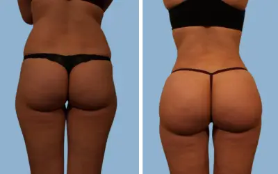 Brazilian butt lift before and after result 8 - BBL performed in India, IndiCure patient