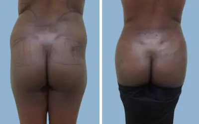 Brazilian butt lift before and after result 9 - BBL performed in India, IndiCure patient