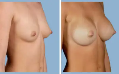 Breast augmentation before and after result 1 - breast implant surgery in India, IndiCure patient