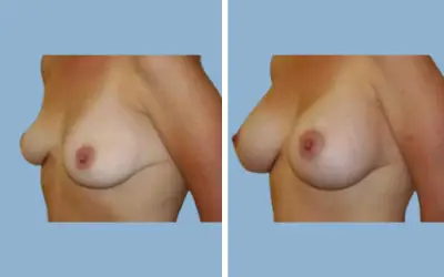 Breast augmentation before and after result 10 - breast implant surgery in India, IndiCure patient