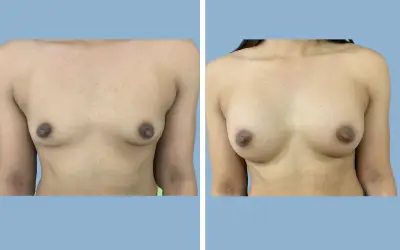 Breast augmentation before and after result 14 - breast implant surgery in India, IndiCure patient