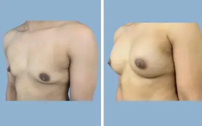 Breast augmentation before and after result 15 - breast implant surgery in India, IndiCure patient