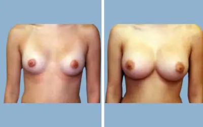 Breast augmentation before and after result 2 - breast implant surgery in India, IndiCure patient