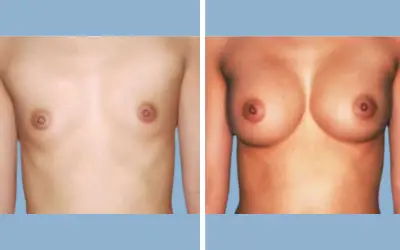 Breast augmentation before and after result 4 - breast implant surgery in India, IndiCure patient