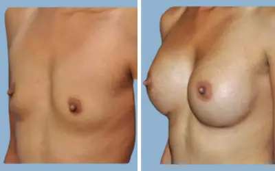 Breast augmentation before and after result 7 - breast implant surgery in India, IndiCure patient
