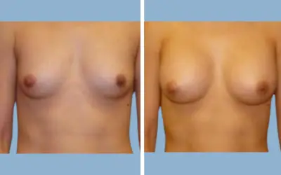 Breast augmentation before and after result 8 - breast implant surgery in India, IndiCure patient