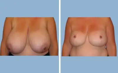 Breast lift and reduction before and after result 1 - performed in India, IndiCure patient