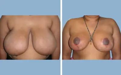 Breast lift and reduction before and after result 10 - performed in India, IndiCure patient