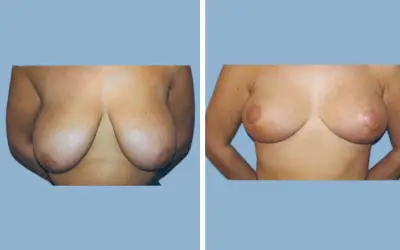 Breast lift and reduction before and after result 13 - performed in India, IndiCure patient