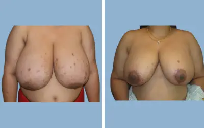 Breast lift and reduction before and after result 15 - performed in India, IndiCure patient