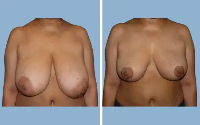 Breast lift and reduction before and after result 16 - performed in India, IndiCure patient
