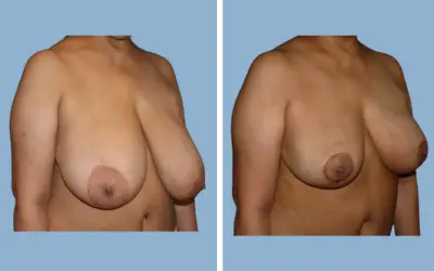 Breast lift and reduction before and after result 17 - performed in India, IndiCure patient