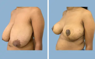 Breast lift and reduction before and after result 18 - performed in India, IndiCure patient