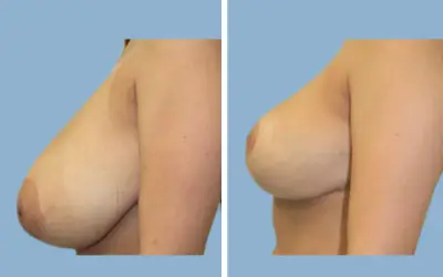 Breast lift and reduction before and after result 2 - performed in India, IndiCure patient