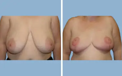 Breast lift and reduction before and after result 5 - performed in India, IndiCure patient