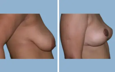 Breast lift before and after result 10 - mastopexy performed in India, IndiCure patient