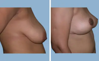 Breast lift before and after result 3 - mastopexy performed in India, IndiCure patient