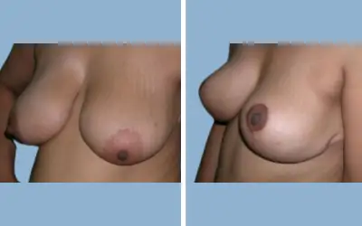 Breast lift before and after result 9 - mastopexy performed in India, IndiCure patient