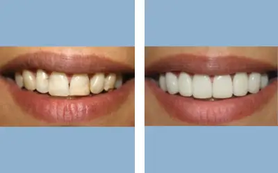 Dental veneers before and after result 1 - smile makeover in India, IndiCure patient