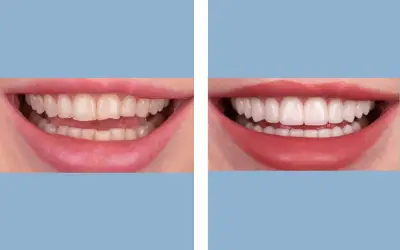 Dental veneers before and after result 2 - smile makeover in India, IndiCure patient