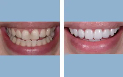 Dental veneers before and after result 3 - smile makeover in India, IndiCure patient