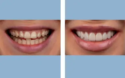 Dental veneers before and after result 4 - smile makeover in India, IndiCure patient