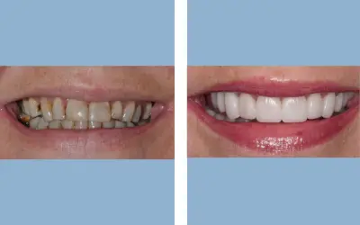 Dental veneers before and after result 5 - smile makeover in India, IndiCure patient