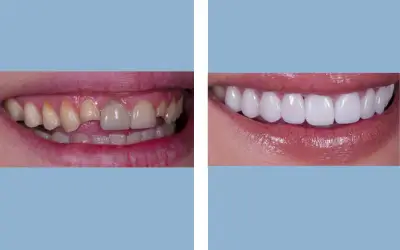 Dental veneers before and after result 6 - smile makeover in India, IndiCure patient