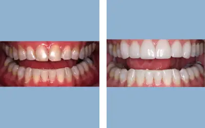 Dental veneers before and after result 7 - smile makeover in India, IndiCure patient
