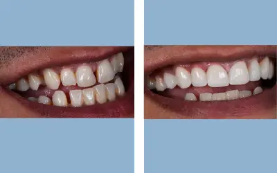 Dental veneers before and after result 8 - smile makeover in India, IndiCure patient
