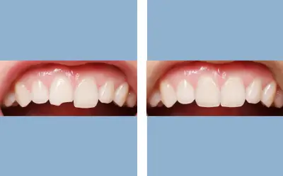 Dental veneers before and after result 9 - smile makeover in India, IndiCure patient