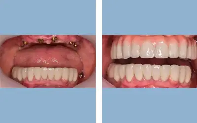 Full mouth dental implants before and after result 1 - performed in India, IndiCure patient