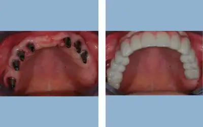 Full mouth dental implants before and after result 2 - performed in India, IndiCure patient
