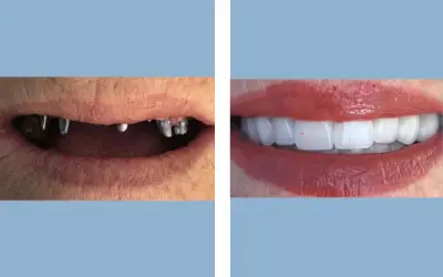 Full mouth dental implants before and after result 3 - performed in India, IndiCure patient