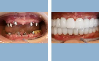 Full mouth dental implants before and after result 4 - performed in India, IndiCure patient