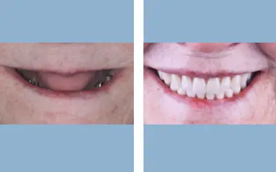 Full mouth dental implants before and after result 5 - performed in India, IndiCure patient