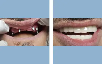 Full mouth dental implants before and after result 6 - performed in India, IndiCure patient