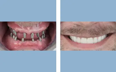 Full mouth dental implants before and after result 7 - performed in India, IndiCure patient