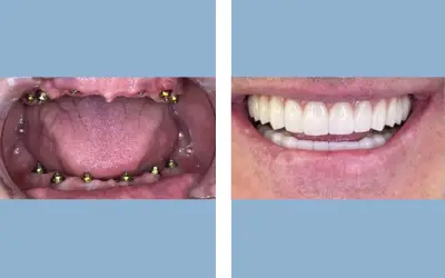 Full mouth dental implants before and after result 8 - performed in India, IndiCure patient