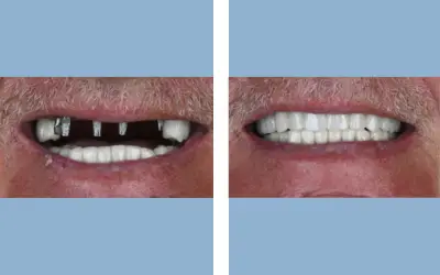 Full mouth dental implants before and after result 9 - performed in India, IndiCure patient