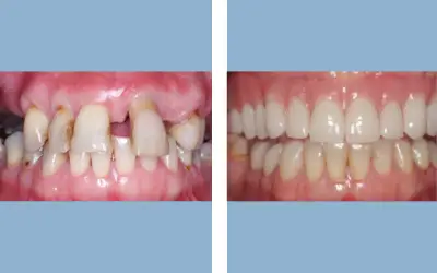 Full mouth rehabilitation before and after result 1 - performed in India, IndiCure patient