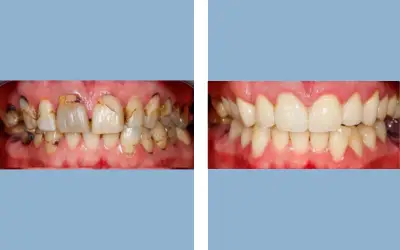 Full mouth rehabilitation before and after result 2 - performed in India, IndiCure patient